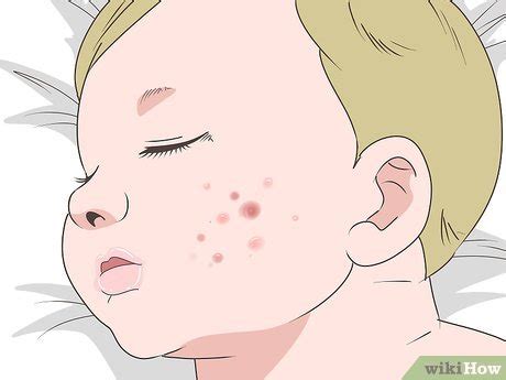 Don't get all worried it if happens to your baby but it is always good to know how to get rid of baby acne beforehand. 3 Ways to Get Rid of Baby Acne - wikiHow