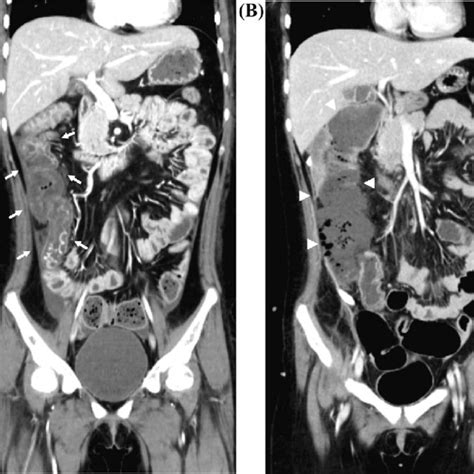 Abdominal Contrast Enhanced Computed Tomography Ct On Days 16 And 27
