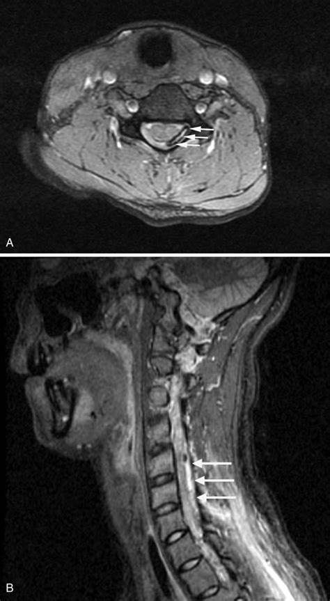 Cervical Spine Mri With Iv Contrast A Axial D Multiple Echo