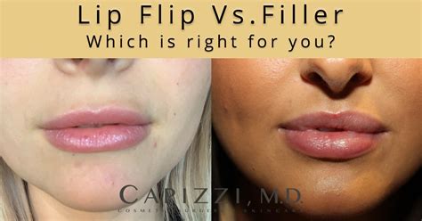 Lip Flip Botox Before And After Photos