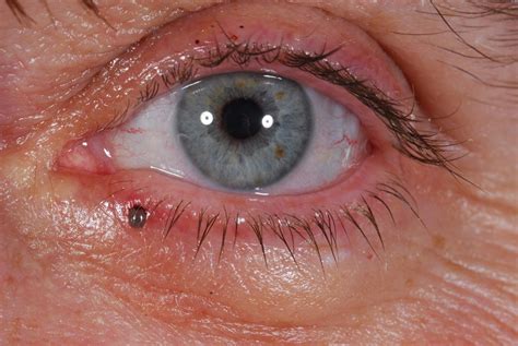 Tick Infestation On The Lower Eyelid A Case Report Cases Journal