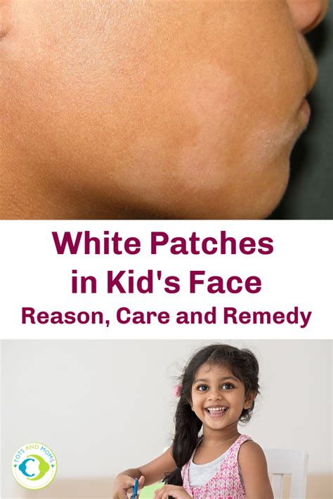 White Patches In Kids Face Reason Care And Remedy
