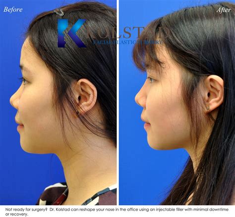 Non Surgical Asian Rhinoplasty San Diego Before And After Gallery 1 Dr Kolstad San Diego