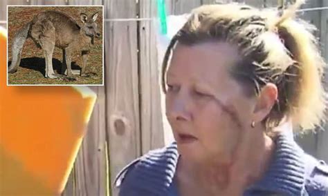 Woman Attacked By Kangaroo Urges People Not To Feed Them