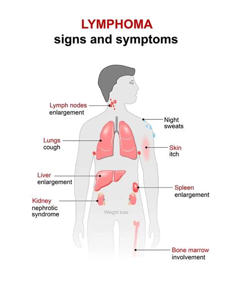 Lymphoma Symptoms Signs Of Hodgkin S Non Hodgkin S Lymphoma