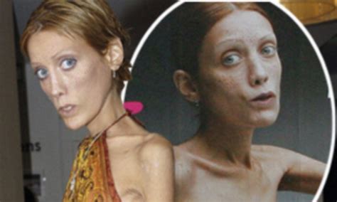 Anorexic Model Isabelle Caro Who Appeared In Shock Fashion Campaign Dies At 28 Rnews