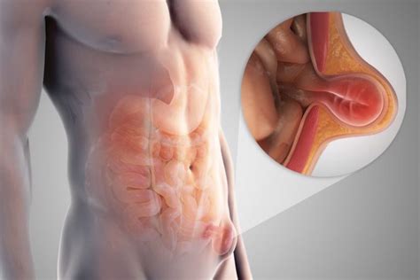 Umbilical Hernia Causes Symptoms Diagnosis And Treatment
