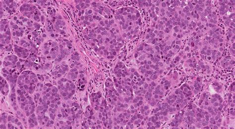 Basaloid Neoplasm Mypathologyreportca