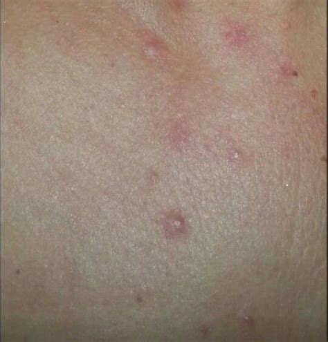 Photosensitivity Lupus Rash From Sun Exposure Lupus Rash Psoriatic