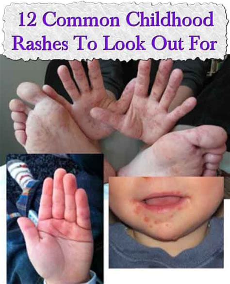 Most Common Childhood Rashes