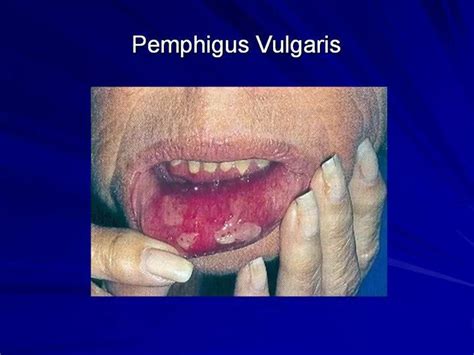 Pemphigus Vulgaris Med School Dermatology Medicine