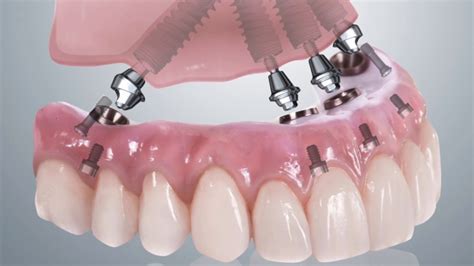 Tipos De Prótesis Limpieza Dental