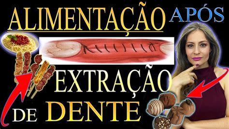 Extrai Um Dente O Que Posso Comer Saiba O Que Comer Ap S Uma Extra O