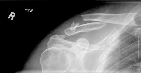Shoulder And Elbow Surgery When Do We Have To Fix Clavicle Fractures