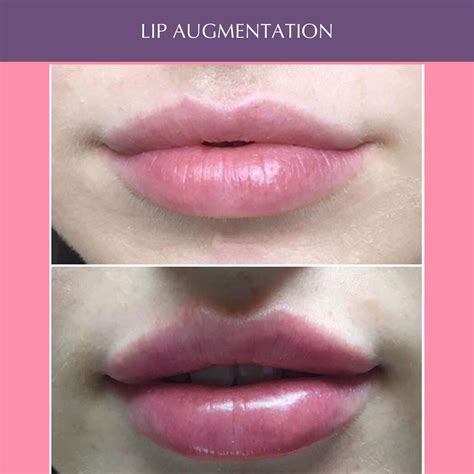 Lip Augmentation Premium Cosmetic Laser Center