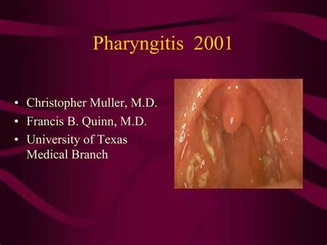 Ppt Pharyngitis 2001 Powerpoint Presentation Free Download Id1357734