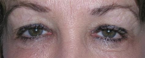 Doctor The Botox Made My Eyelids Droop