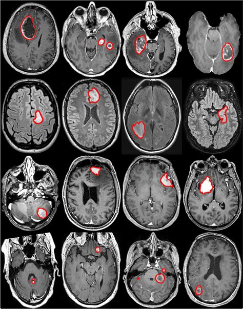 Figure From Brain Tumor Detection In Mri Brain Im Vrogue Co