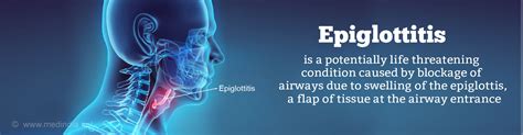 Epiglottitis Causes Signs And Symptoms Diagnosis Treatment