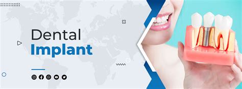 Why You May Need Dental Implants Medlife Group