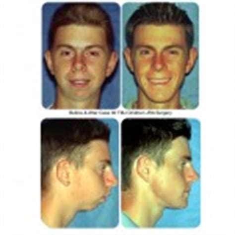 Before After Surgery Photos Dr Larry M Wolford Dmd