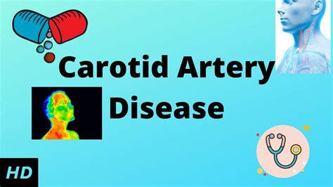 Carotid Artery Disease Causes Signs And Symptoms Diagnosis And