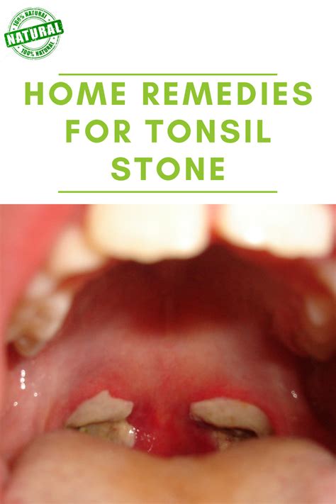 10 Home Remedies For Tonsil Stones Artofit
