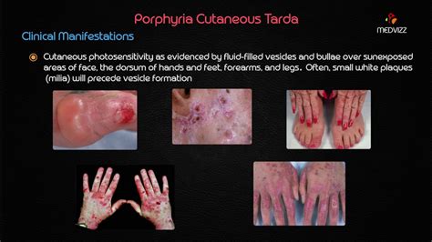 Porphyria Cutanea Tarda Legs