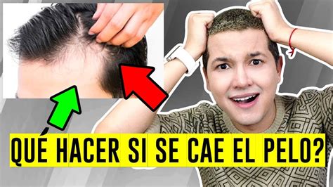 Por QuÉ Se Cae El Cabello ¿quÉ Hacer Calvicie Alopecia CaÍda Del