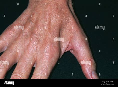 Muscle Wasting In Hand Due To Ulnar Nerve Damage Photograph By Science My XXX Hot Girl
