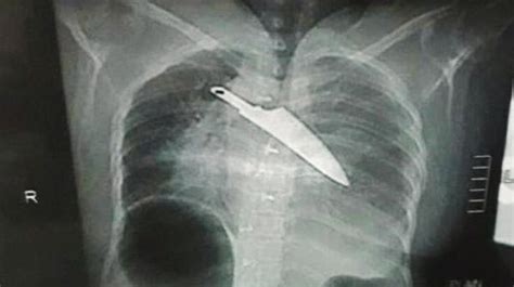 30 Hours After Stabbing Knife Removed From Womans Chest The Hindu