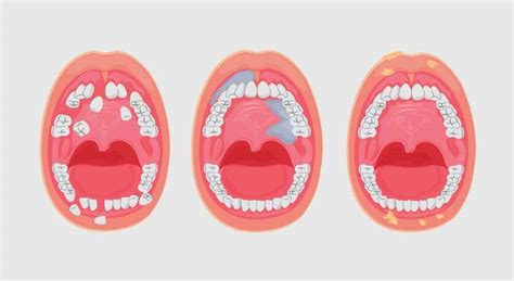 Oral Cancer Symptoms Markham Markham Dentist Forestbrook Dental
