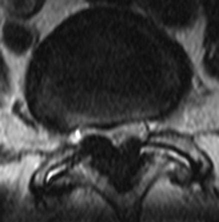Excessive ligamentum flavum hypertrophy causing lumbar spinal stenosis