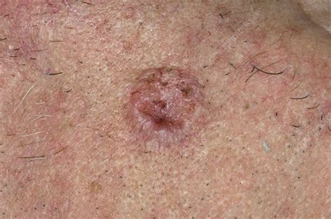 Basal Cell Carcinoma On The Face Stock Image C0029635 Science