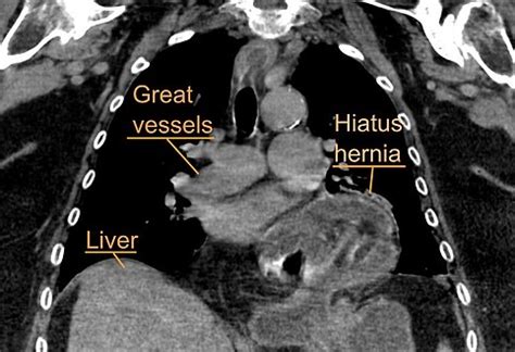 Medicine Hiatal Hernia Handwiki