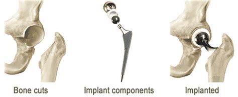 Total Hip Replacement Implants