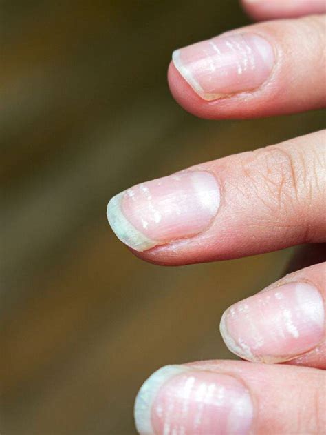 What Deficiency Causes White Spots On Nails The Indian Express