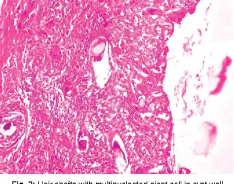 A Rare Case Of Vaginal Dermoid Cyst A Case Report And Review Of