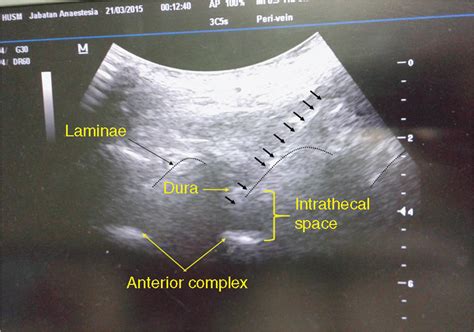 Real Time Ultrasound Guided Paramedian Spinal Anaesthesia Evaluation