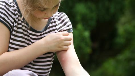 Mosquito Bites Symptoms Treatment Prevention And More Goodrx