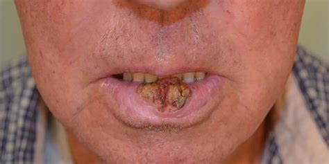Squamous Cell Carcinoma Of The Lower Lip Affecting Central Lip