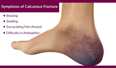 Symptoms Of Calcaneus Fracture Or Broken Heel Calcaneus Fracture Heel Treatment Fracture