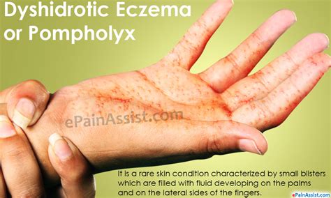 Dyshidrotic Eczema Dyshidrosis Symptoms Causes Treatm