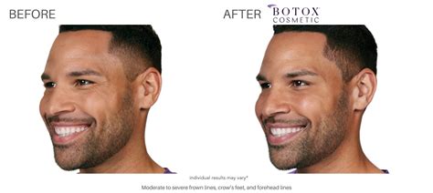 Botox Before And After Real Patient Results In Chatham