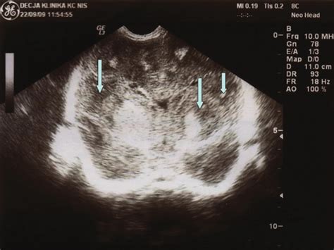 Coronal Images Of Transcranial Ultrasound Scan Showing Echolucent Areas