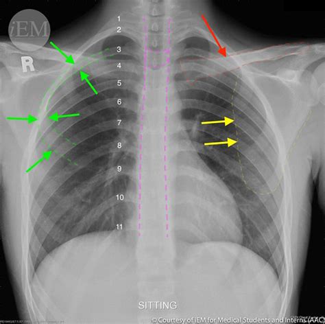 How To Read Chest X Rays International Emergency Medicine Education
