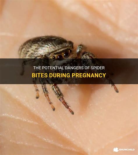 The Potential Dangers Of Spider Bites During Pregnancy Shunchild