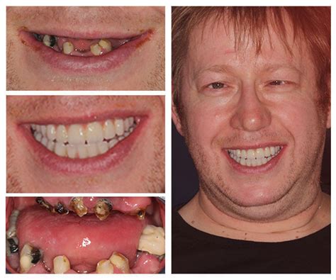 Teeth Whitening Camden Place Dental Practice Preston