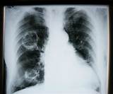 How Do Doctors Test For Pneumonia Images