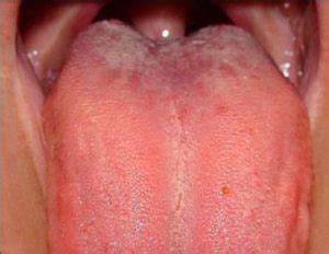 It's tough to watch taste buds in action—you can't clamp a microscope onto a subject's tongue. Swollen Taste Buds, Inflamed, Causes on Sides, Tip, Under ...